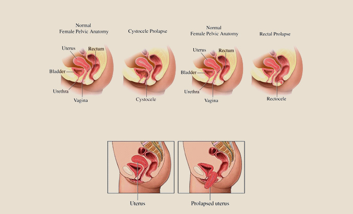 http://www.womenscentre.net/index.php?option=com_rsblog&view=post&id=29:determining-the-stages-of-prolapsed-uterus&Itemid=188